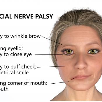 Bell's palsy