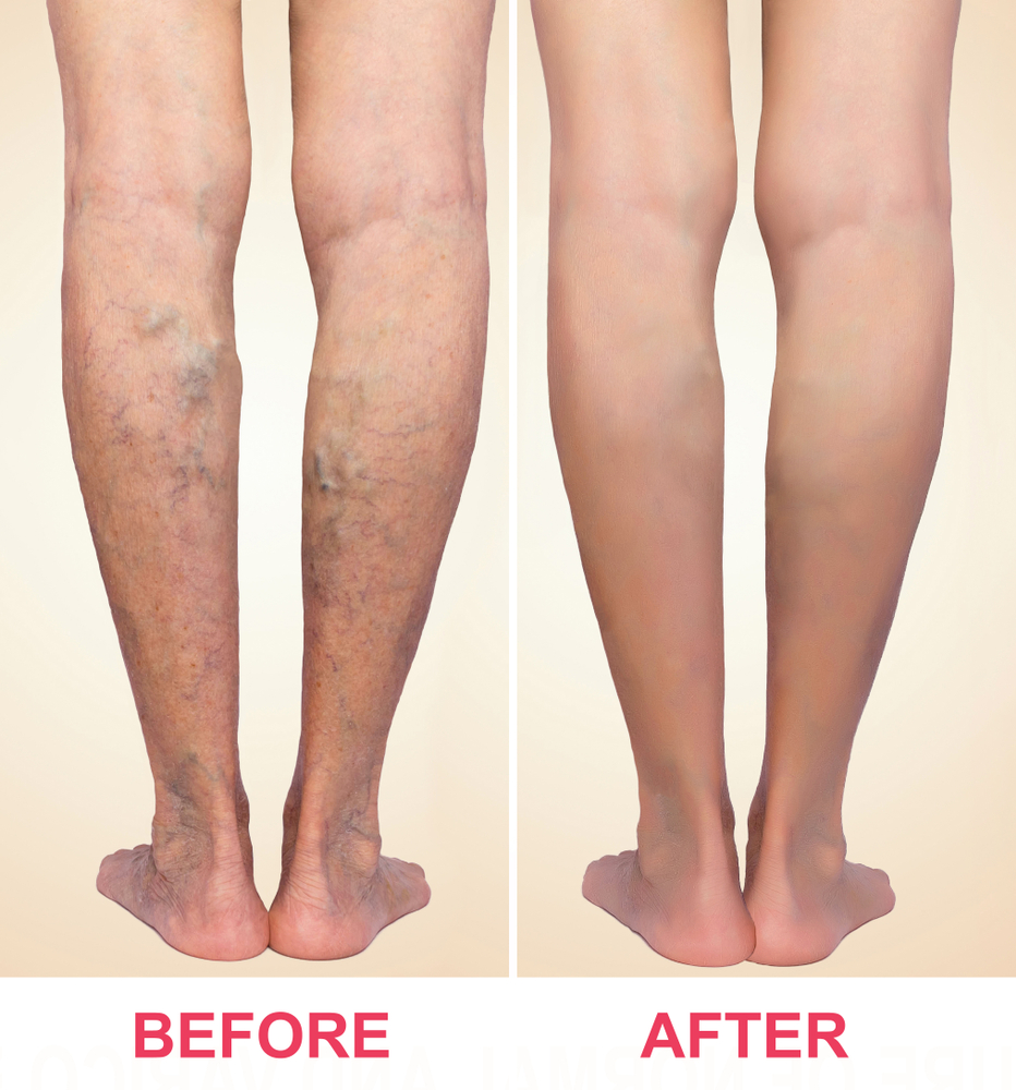 home-treatments-for-varicose-veins-the-vein-company